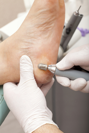 Simply Foot Care, Chiropody and Podiatry in Dursley Gloucestershire